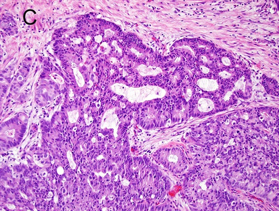 Prostatakarzinom 
Gleason-Pattern 4
Prostatakarzinom mit kribriformem Wuchsmuster